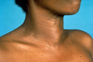 An egg-shaped lump on the lower front of a woman's neck.