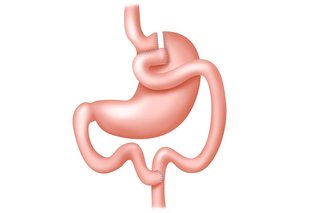 Diagram of a stomach with a gastric bypass connecting the top of the stomach to the lower intestine.