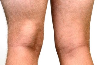 Lower legs of a person with white skin shown from the back, on white background. The left leg has a large lump from the knee joint up towards the middle of the thigh.